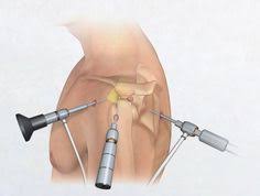 1.Αρθροσκόπηση ώμου