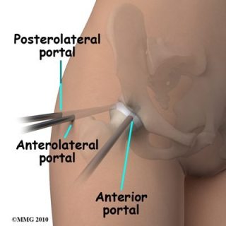 3.Αρθροσκόπηση ισχίου
