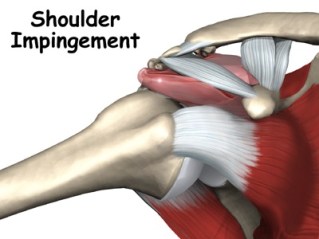 A.Σύνδρομο υπακρωμιακής προστριβής