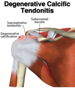 C.Ασβεστοποιός τενοντίτιδα υπερακανθίου