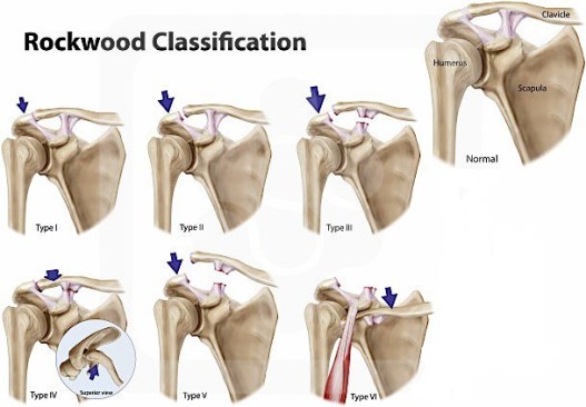 I.Ρήξη ακρωμιοκλειδικής Άρθρωσης