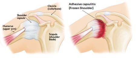 J.Παγωμένος ώμος