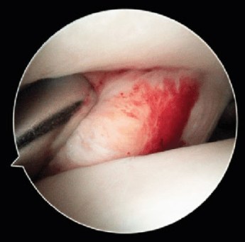 f.Υμενίτιδα Ποδοκνημικής