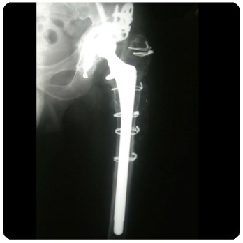 Ακτινογραφία με κοτύλη-κλωβό