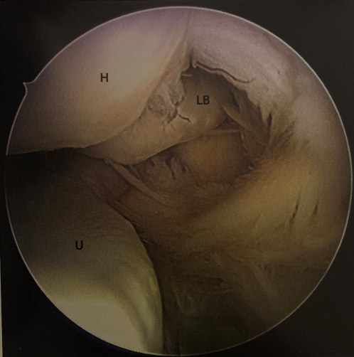 Β.Διαχωριστική οστεοχονδρίτιδα