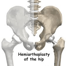 Ημιαρθροπλαστική Ισχίου