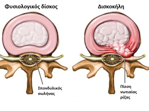 1.Δισκοκήλη