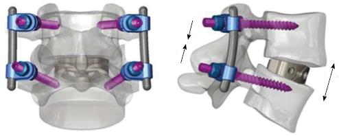 1.Οπίσθια σπονδυλοδεσία