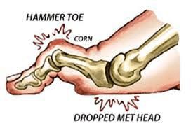 A.Πτώση κεφαλών μεταταρσίων