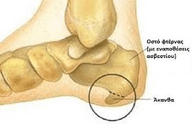 B.Δημιουργία άκανθας πτέρνας