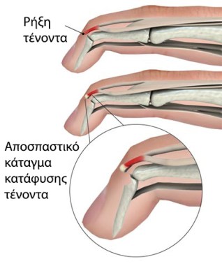 C.Ρήξη εκτείνοντα δακτύλων(mallet finger)