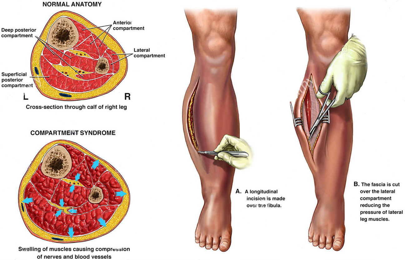 Διαμερίσματα κνήμης και διάνοιξη τους