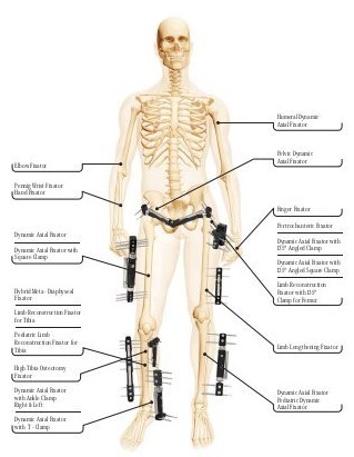 Εξωτερική οστεοσύνθεση-ΕΞΩΦΥΛΛΟ