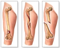 Κάταγμα κάτω άκρου-ΕΞΩΦΥΛΛΟ