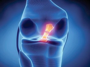 Ρήξη συνδέσμων-ΕΞΩΦΥΛΛΟ