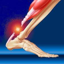 Ρήξη τενόντων-ΕΞΩΦΥΛΛΟ