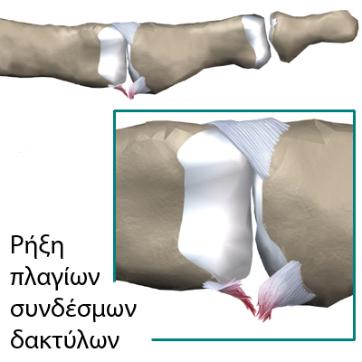 F.Ρήξη πλαγίων συνδέσμων δακτύλων