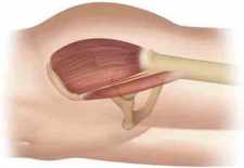 Προσθιοπλάγια-έξω-προσπέλαση..