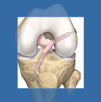 Τεχνική All-Inside-ΕΞΩΦΥΛΛΟ