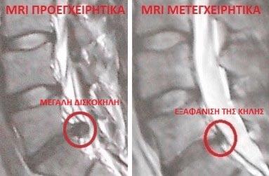 MRI of prior surgery VS post surgery