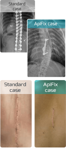 STANDARD VS APIFIX CASE